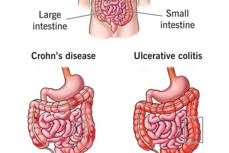 Inflammatory Bowel Disease (IBD)