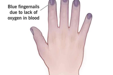 Cyanosis