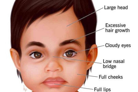 Hurler Syndrome
