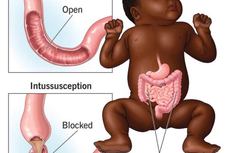 Intussusception