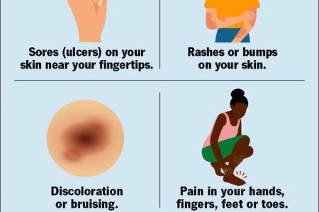 Rheumatoid Vasculitis