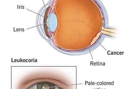 Retinoblastoma