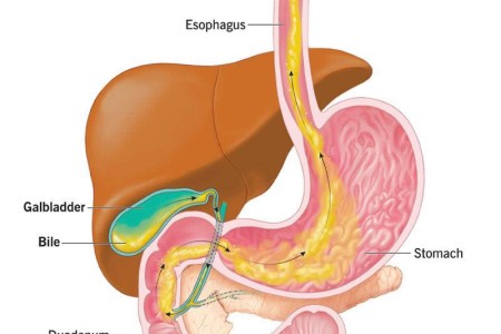 Bile Reflux