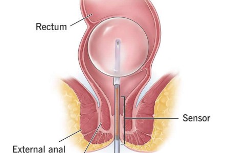 Anorectal Manometry