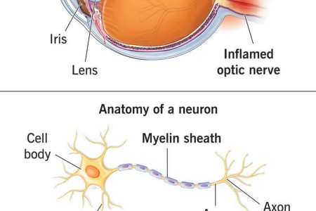 Optic Neuritis