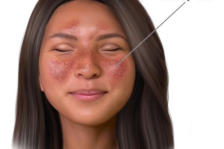 Lupus in Children