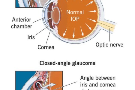 Angle-Closure Glaucoma