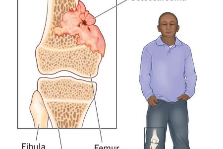 Osteosarcoma (Osteogenic Sarcoma)