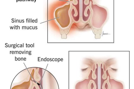 Functional Endoscopic Sinus Surgery (FESS)