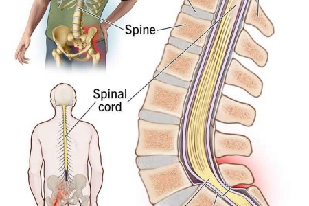 Sciatica