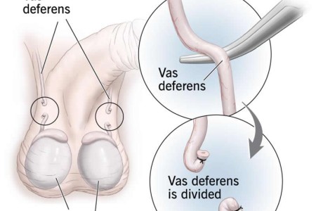 Vasectomy