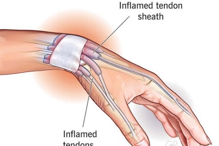 De Quervain’s Tendinosis