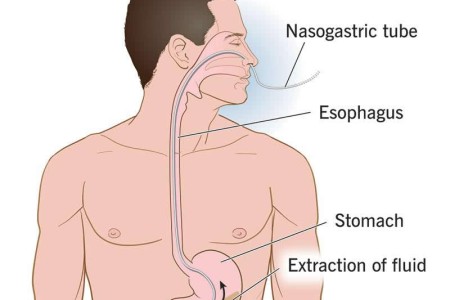 Stomach Pumping