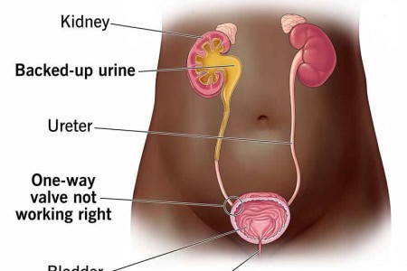 Vesicoureteral Reflux