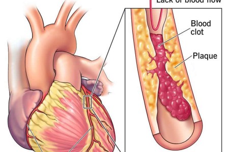 Coronary Artery Disease