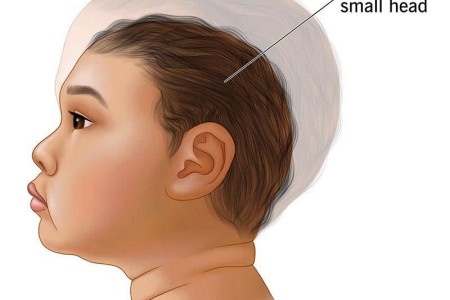 Microcephaly