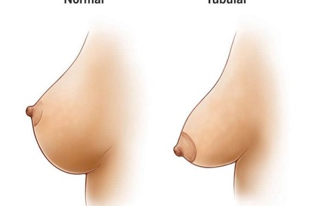 Tubular Breasts