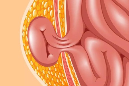 Can Heavy Lifting and Exercise Cause a Hernia?