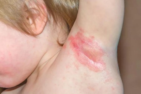 Where Can You Get a Yeast Infection on Your Body?