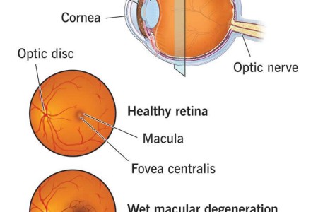 Wet Macular Degeneration