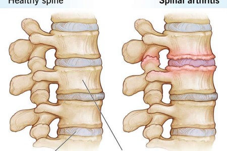 Spinal Arthritis