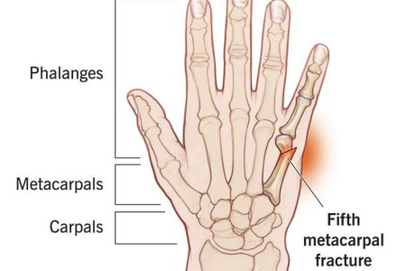 Boxer’s Fracture