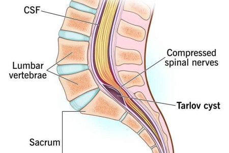 Tarlov Cyst