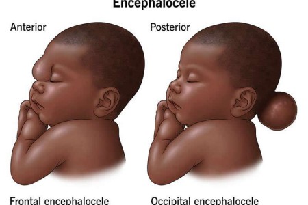 Encephalocele
