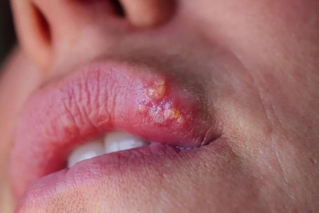 Why Do I Get Cold Sores? Common Triggers Explained