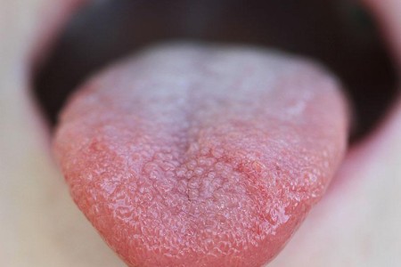 Transient Lingual Papillitis (Lie Bumps)