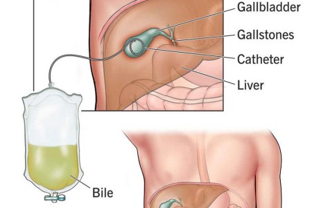 Cholecystostomy