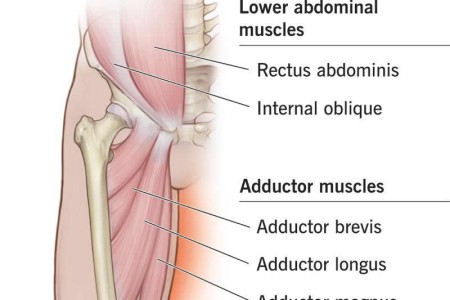 Groin Strain
