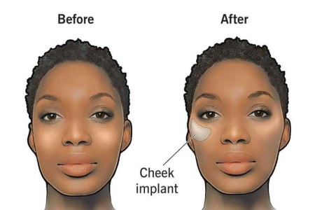 Cheek Implants
