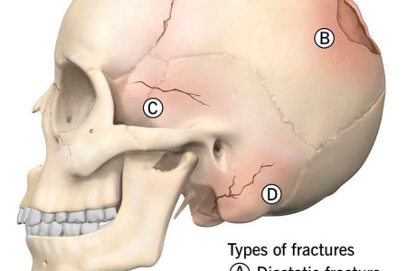 Skull Fracture