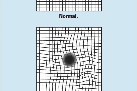 Amsler Grid Eye Test