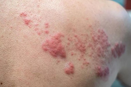 No, You Can’t Get Shingles if You’ve Never Had Chickenpox