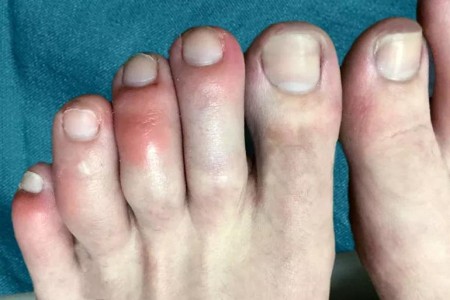 Are COVID Toes and Rashes Common Symptoms of the Coronavirus?