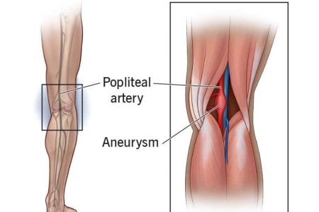 Popliteal Aneurysm