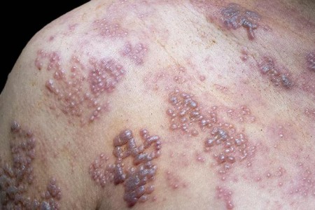 Is the Shingles Vaccine Worthwhile?