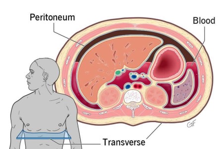 Hemoperitoneum