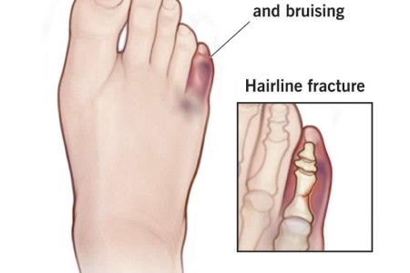 Broken Toe (Fractured Toe)
