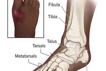 Broken Foot (Fractured Foot)