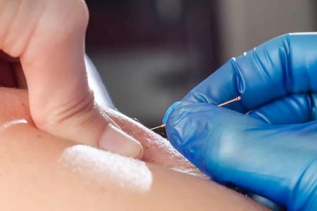 Dry Needling: What It Is and How It Works
