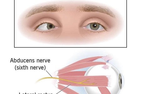 Sixth Nerve Palsy