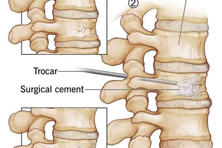 Vertebroplasty