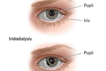 Iridodialysis