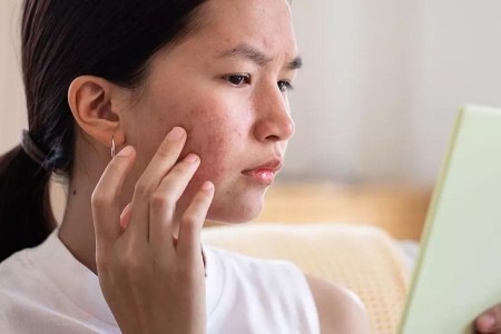 Home Remedies for Acne: Do They Work?