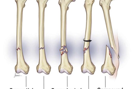 Broken Leg