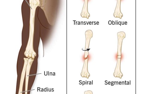 Broken Arm (Fractured Arm)