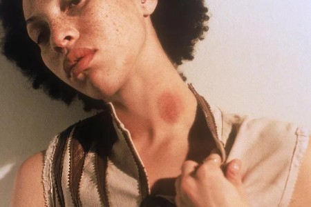 How To Get Rid of Your Hickey, Fast